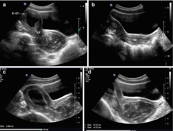 The Diagnosis of Female Reproductive Tract Anomalies | Obgyn Key