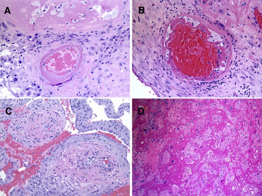 Neonatal outcomes following preterm birth classified according to ...