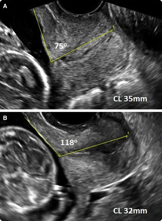 Uterocervical Angle: A Novel Ultrasound Screening Tool To Predict ...