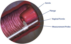 Ultrasound Evaluation of the Gravid Cervix