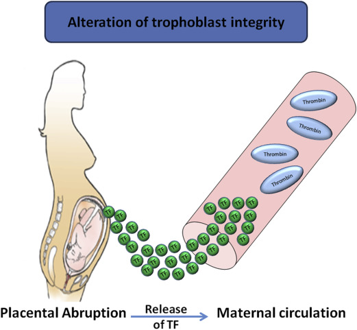 Disseminated Intravascular Coagulation In Pregnancy: Insights In ...