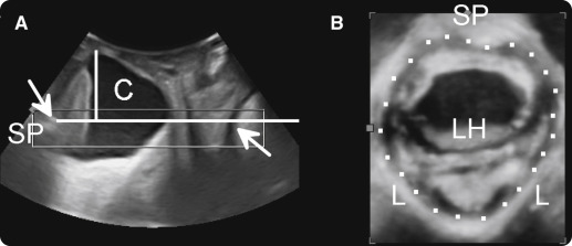 The association between maternal age at first delivery and risk of ...