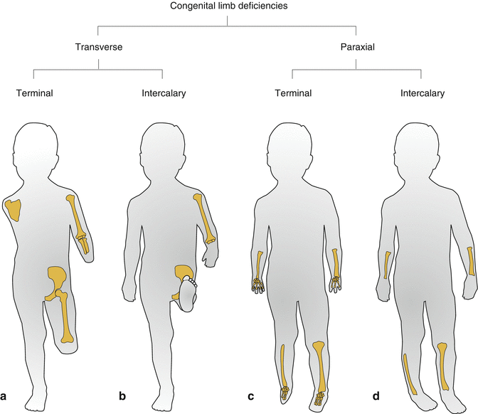 Limb And Back Reduction Deficiency Present At Birth | Obgyn Key