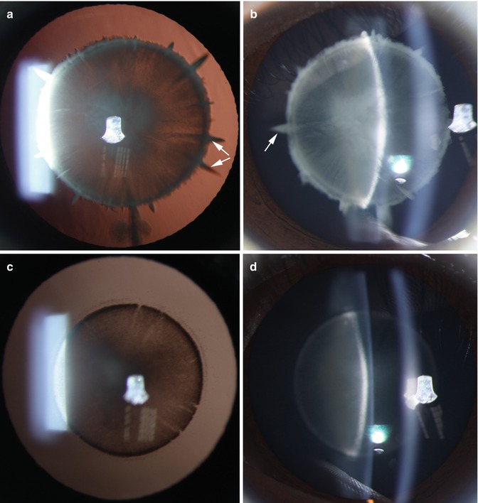 Anterior Axial Embryonic Cataract