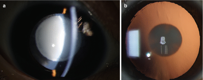 Classification And Morphology Of Pediatric Cataracts | Obgyn Key