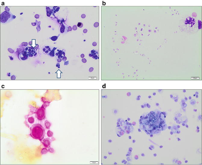 CSF And CNS Cytology | Obgyn Key