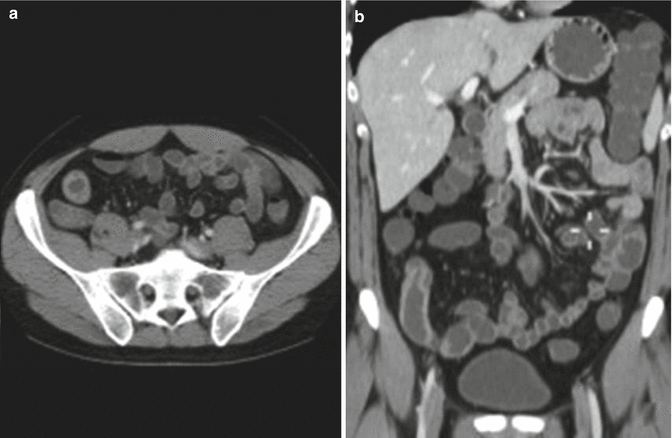 Gastro-Intestinal Tract Radiology | Obgyn Key