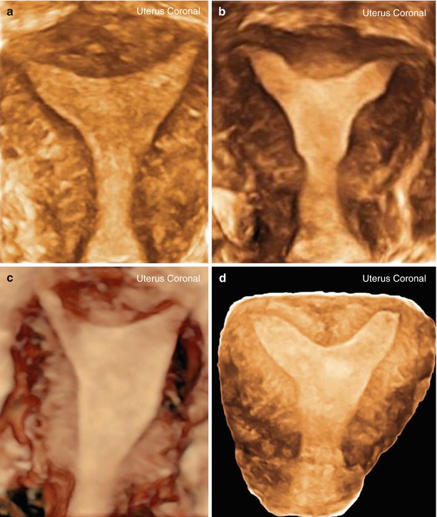 Ultrasound Evaluation Of Congenital Uterine Anomalies | Obgyn Key