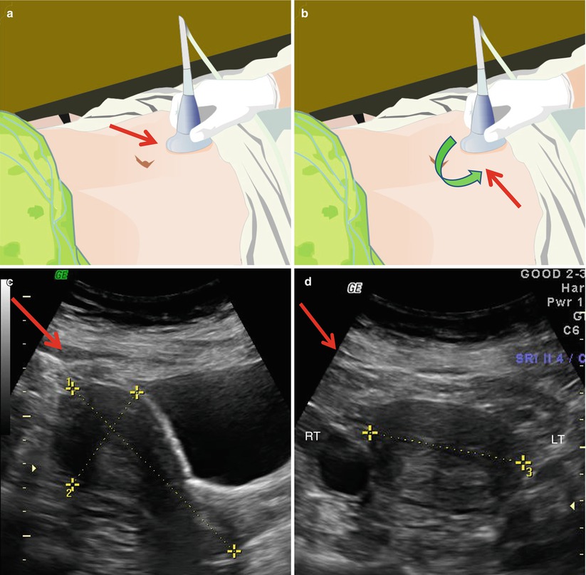 General Techniques In Gynecological Ultrasound | Obgyn Key