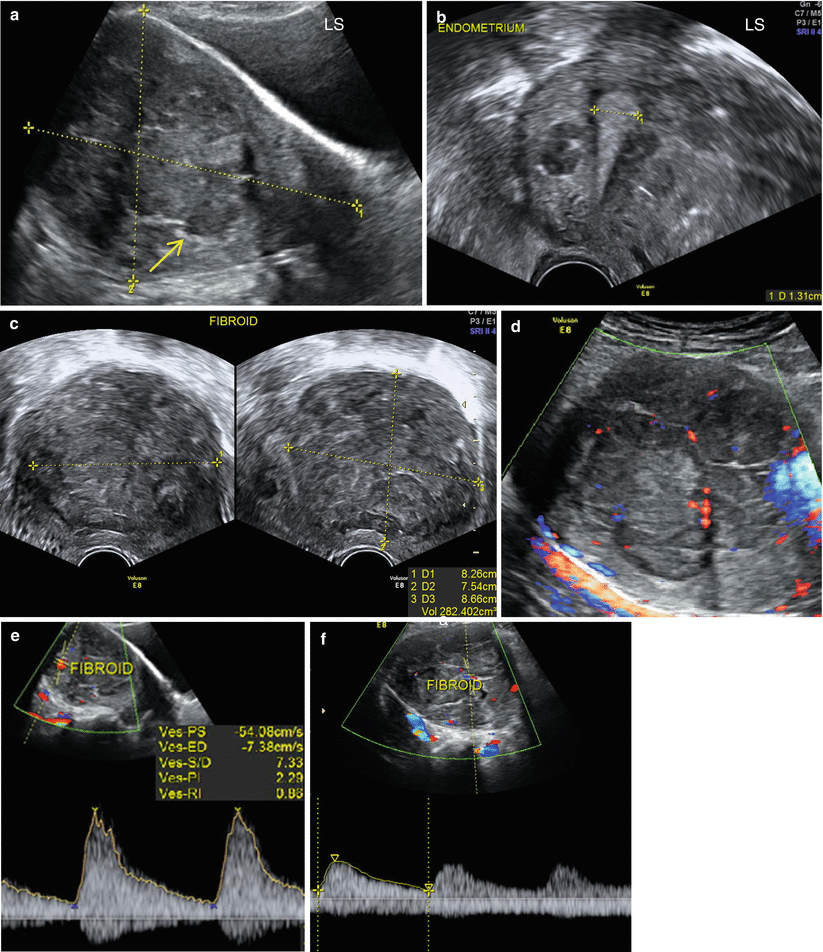 Ultrasound Evaluation Of The Uterus Radiology Key