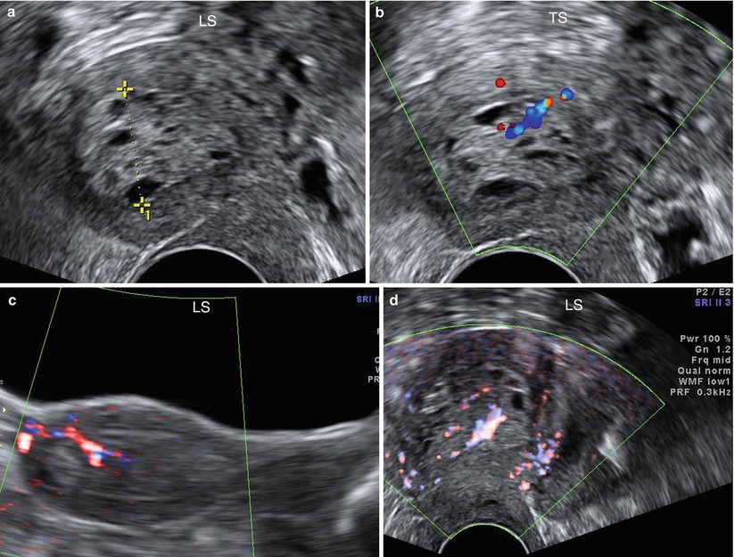 Ultrasound Evaluation Of Endometrium | Obgyn Key