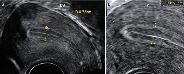 Uterine Lining Measurements