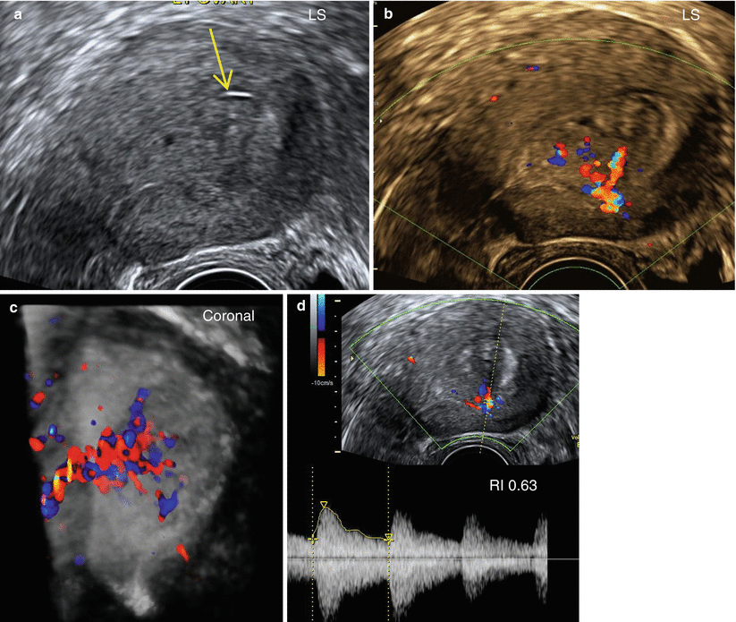 Ultrasound Evaluation Of Endometrium | Obgyn Key