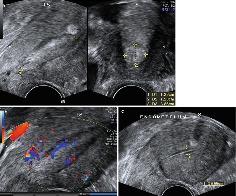 Ultrasound Evaluation Of Endometrium | Obgyn Key