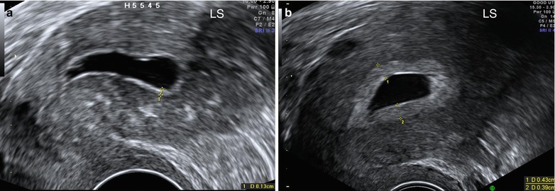 Ultrasound Evaluation Of Endometrium | Obgyn Key