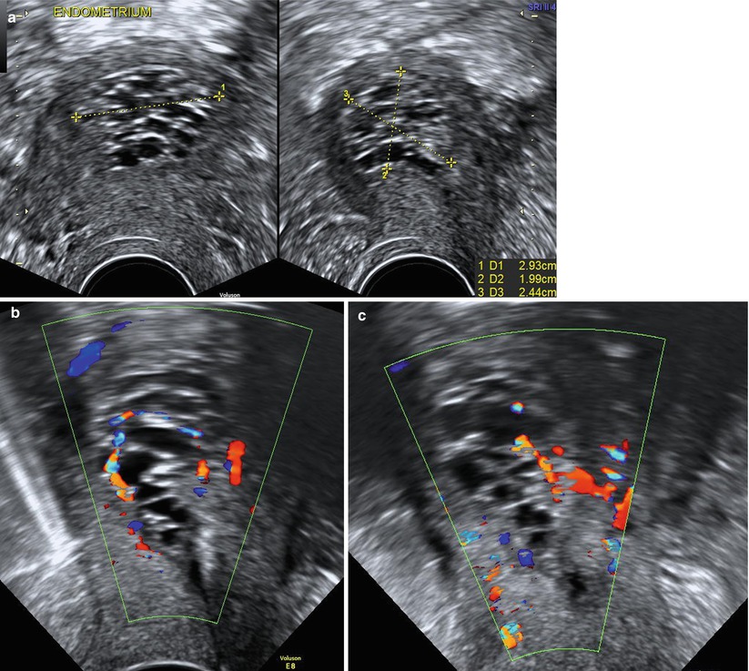 Ultrasound Evaluation Of Endometrium | Obgyn Key