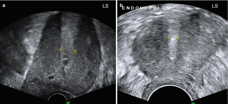 Ultrasound Evaluation Of Endometrium | Obgyn Key