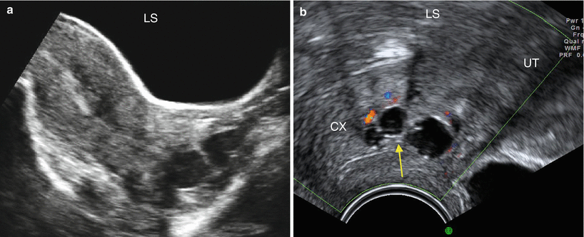 Ultrasound Evaluation Of The Cervix | Obgyn Key