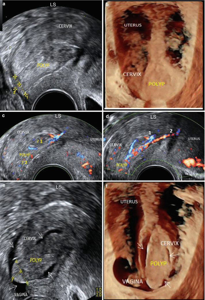 Ultrasound Evaluation Of The Cervix | Obgyn Key