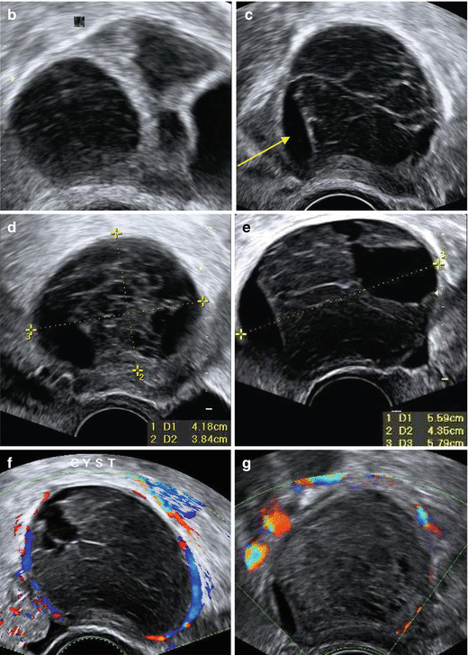 Ultrasound Evaluation Of Ovaries | Obgyn Key