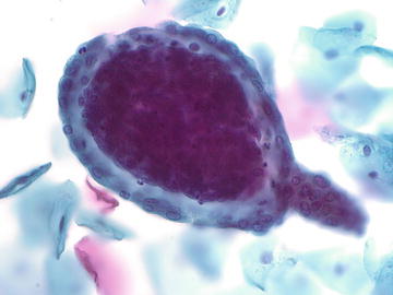 Cytology Of Endometrial Cells And Lesions | Obgyn Key