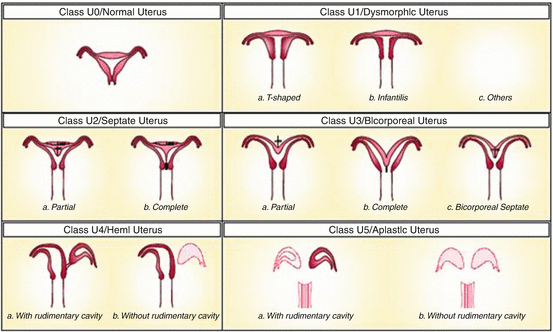 Congenital Uterine Anomalies | Obgyn Key