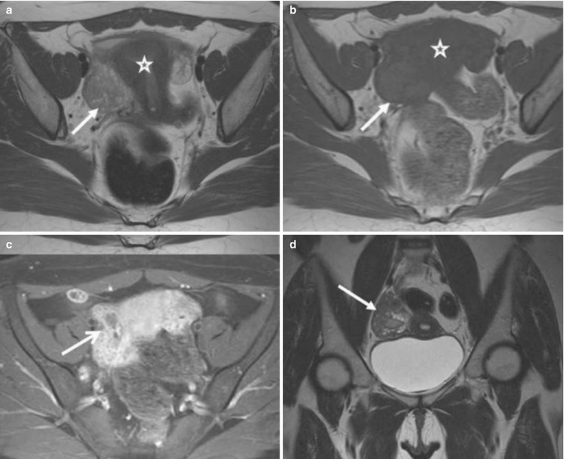 Pelvic Inflammatory Disease | Obgyn Key