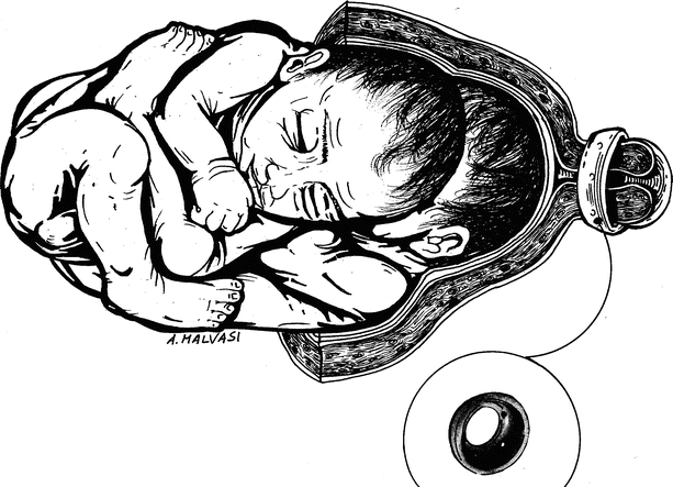 Twin Pregnancies Obgyn Key