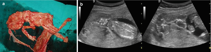 Twin Pregnancies Obgyn Key