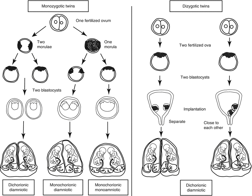 Twin Pregnancies Obgyn Key