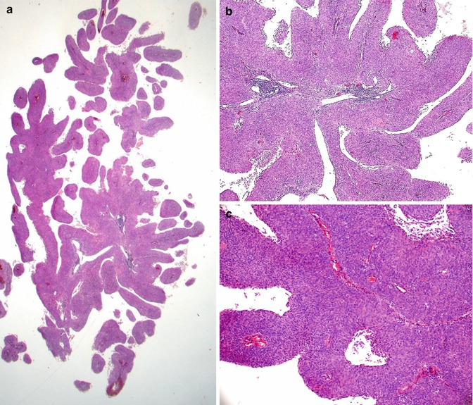 Squamous Cell Carcinoma Of The Cervix | Obgyn Key