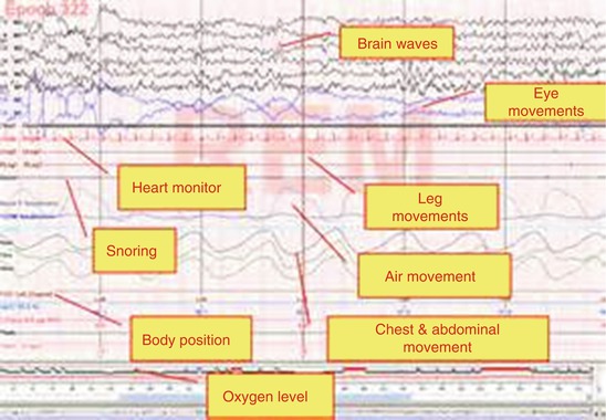 Clinical Management Of Menopause-Related Sleep Disturbance | Obgyn Key