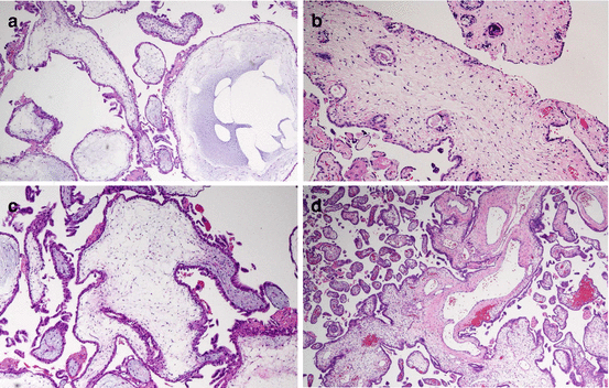 Pathology And Genomics In Gestational Trophoblastic Neoplasia | Obgyn Key