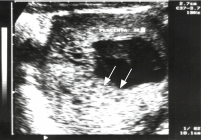 Multiple Gestation Obgyn Key