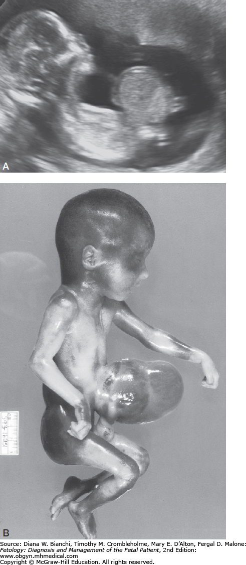 Omphalocele | Obgyn Key