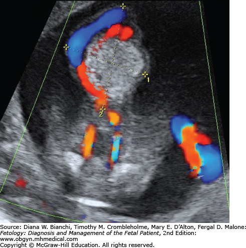 Omphalocele | Obgyn Key