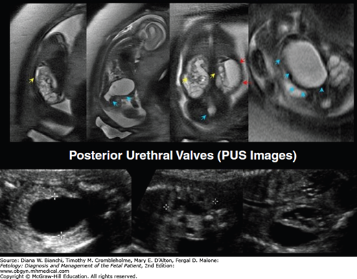 Hydronephrosis: Bladder Outlet Obstruction | Obgyn Key