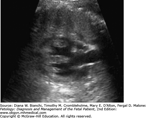 2 Deletion (DiGeorge Syndrome) | Obgyn Key