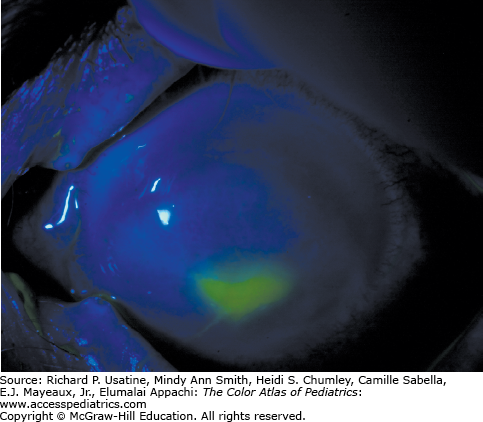 Corneal Foreign Body And Corneal Abrasion | Obgyn Key