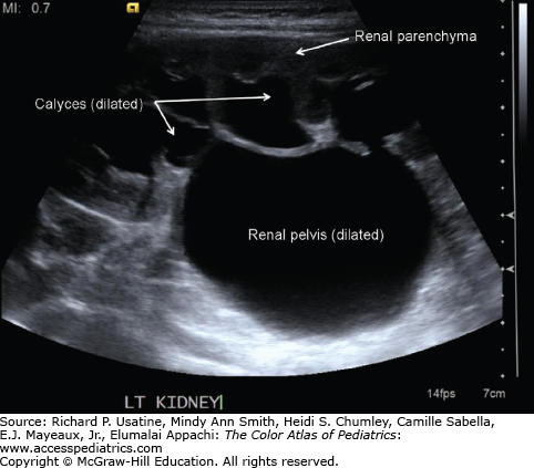 Hydronephrosis And Ureteropelvic Junction Obstruction | Obgyn Key