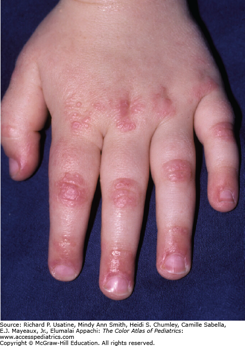 Juvenile Dermatomyositis | Obgyn Key