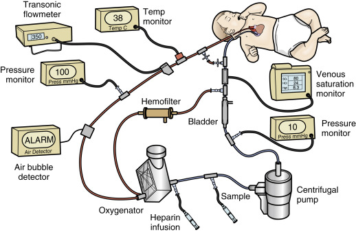 Extracorporeal Membrane Oxygenation | Obgyn Key