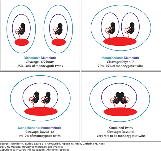 Multiple Gestations | Obgyn Key