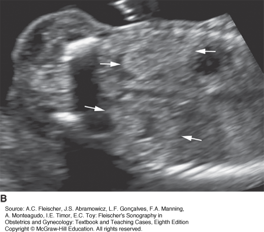 The Fetal Genitourinary System | Obgyn Key