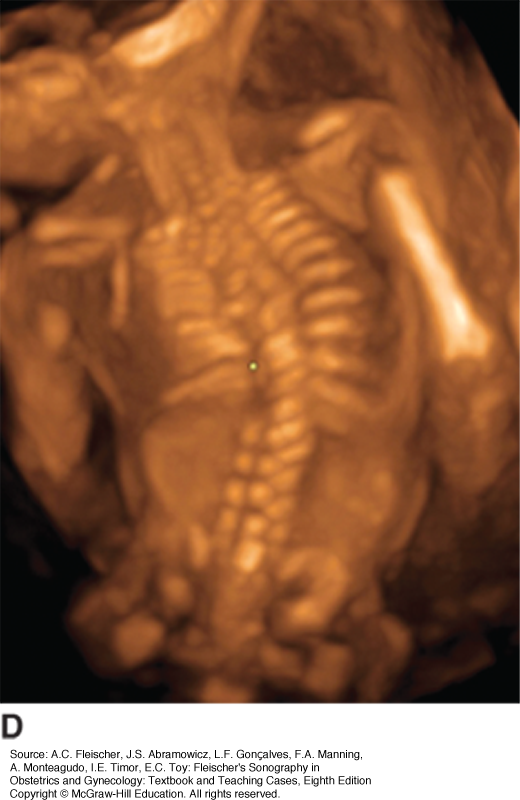 Prenatal Diagnosis Of Skeletal Anomalies | Obgyn Key