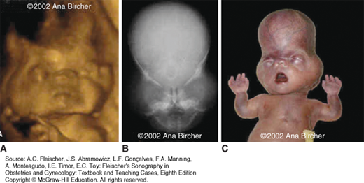 Prenatal Diagnosis Of Skeletal Anomalies | Obgyn Key