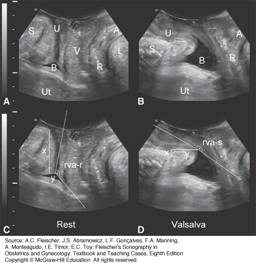 Pelvic Floor Ultrasound | Obgyn Key