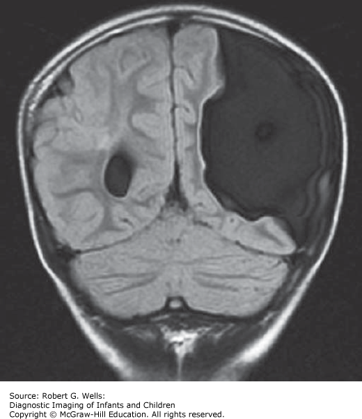 Congenital Abnormalities Of The Brain | Obgyn Key