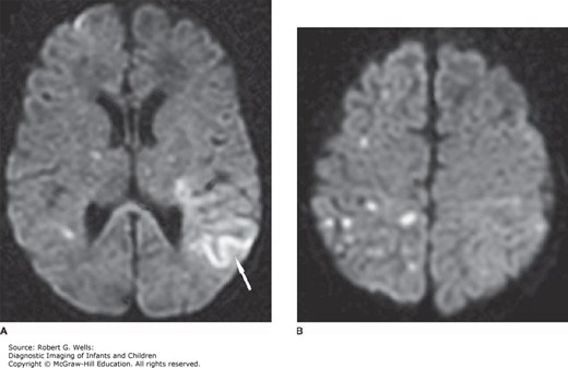 Intracranial Infections | Obgyn Key