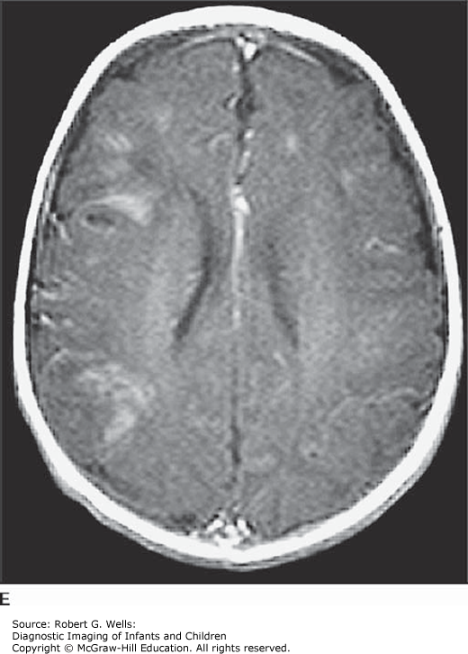 Intracranial Infections | Obgyn Key